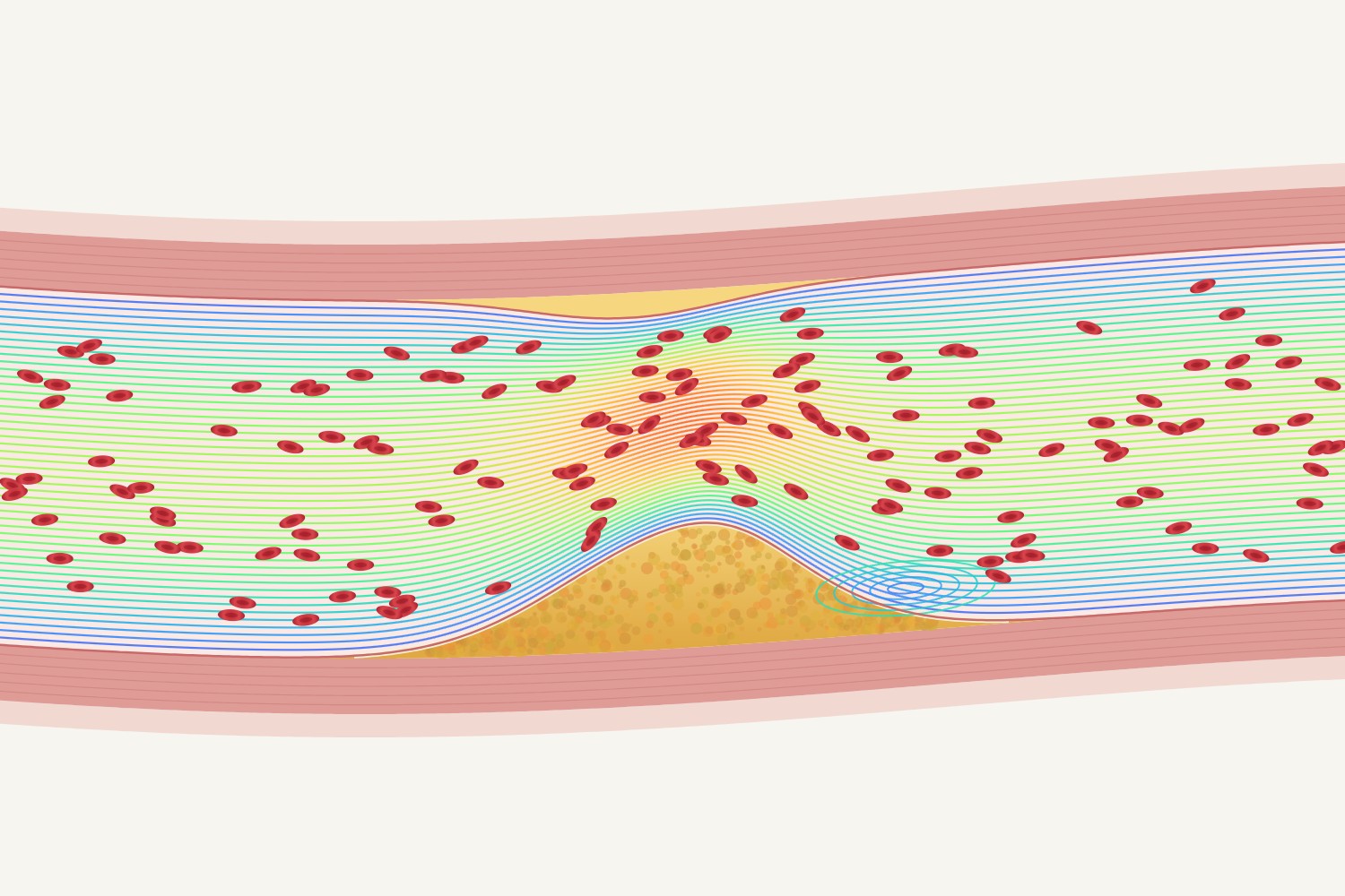 Blood flow through an artery narrowed by plaque, streamlines coloured by velocity